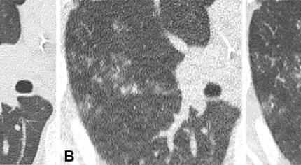 Dada Non-Contrast CT Lung Window Images pada peserta pria berusia 70 tahun