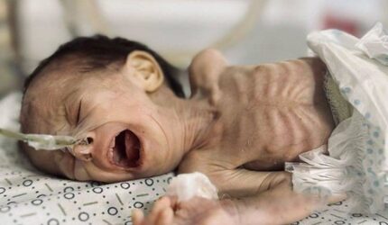 Gadis muda Palestina kelaparan sampai mati di Gaza