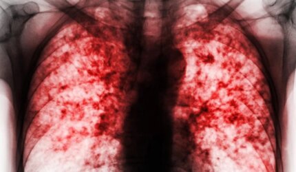 Terobosan Senyawa Baru Dapat Mengobati Penyakit Menular Paling Mematikan di Dunia 3 Rontgen Paru Tuberkulosis Paru