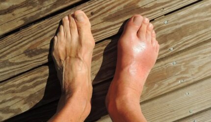 Asam Urat Kaki Bengkak