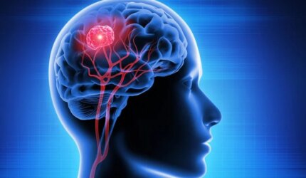 Pembuluh Darah Tumor Kanker Otak Kepala Manusia 3D