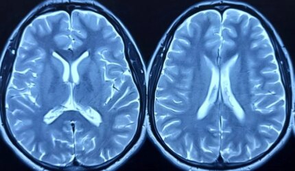Perbandingan Pemindaian Otak MRI