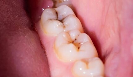 Gigi Berlubang Gigi Kunyah