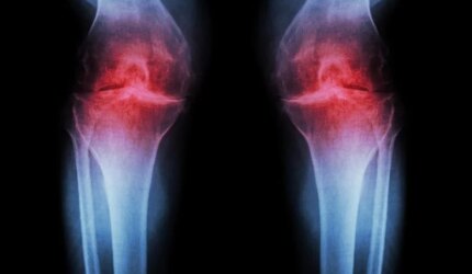 Osteoartritis Lutut