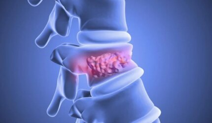 Semen Tulang Stabilisasi Vertebroplasti Tulang Belakang