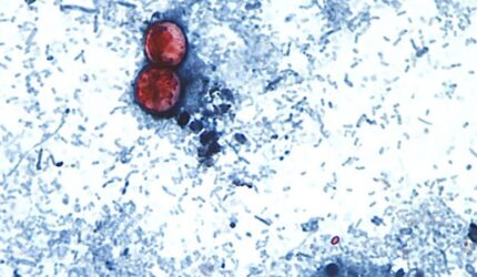 Wabah siklosporiasis besar-besaran terkait dengan empat negara bagian lainnya